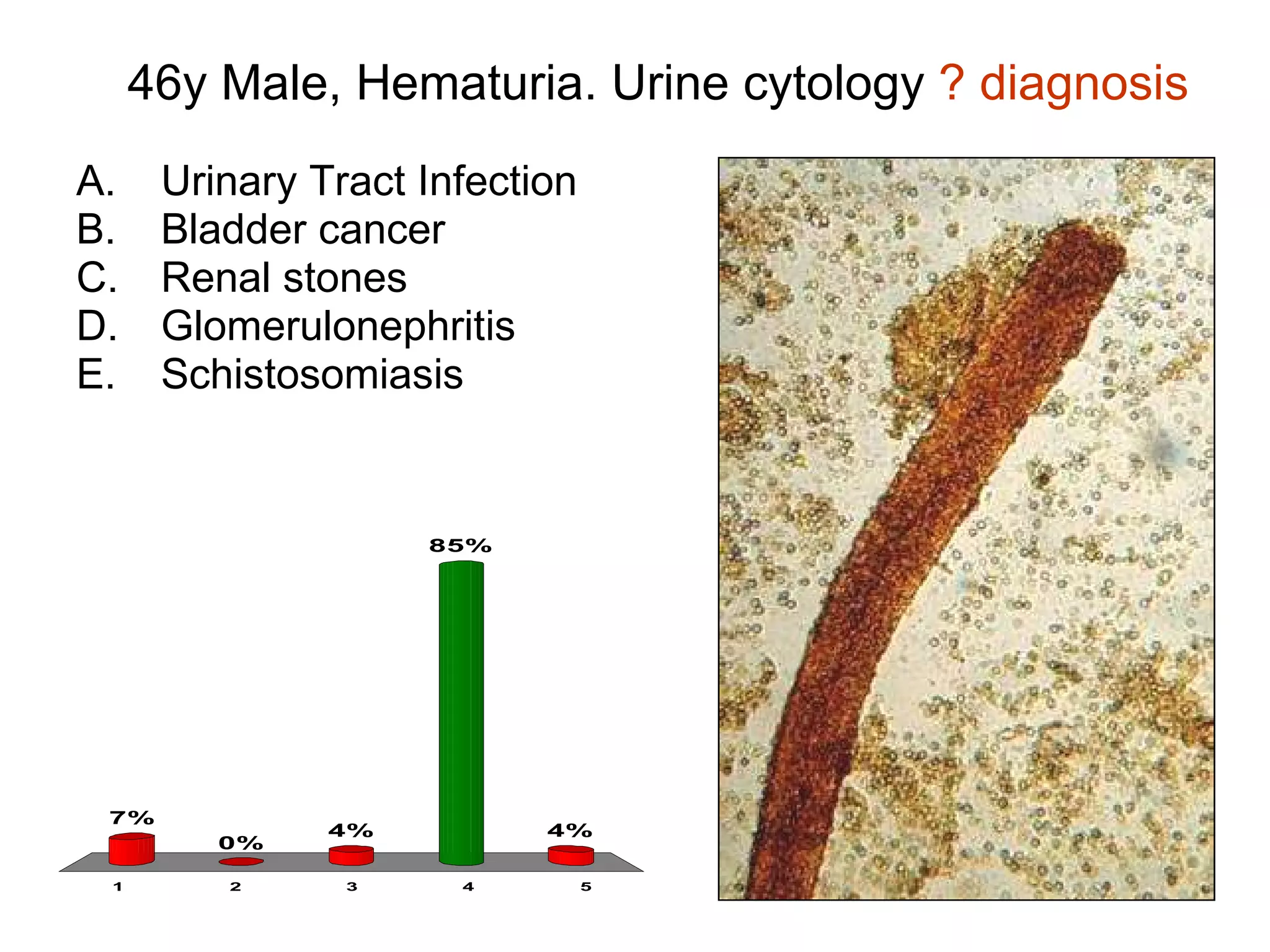 46y Male, Hematuria. Urine cytology  ? diagnosis Urinary Tract Infection Bladder cancer Renal stones Glomerulonephritis Schistosomiasis 