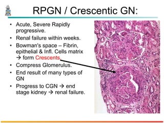 Crescentic Rpgn Pathology of Glomerulonephritis | PPT