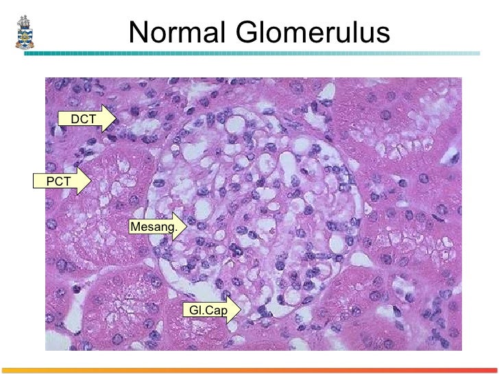 Pathology of Glomerulonephritis