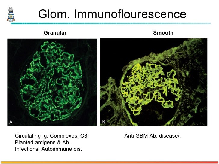 Pathology of Glomerulonephritis