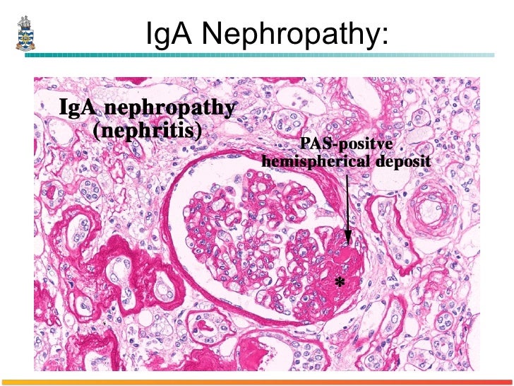 Pathology of Glomerulonephritis