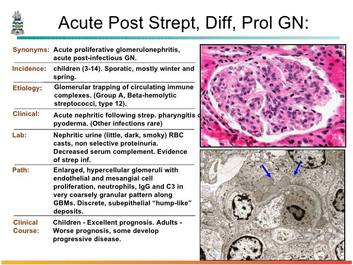 Pathology of Glomerulonephritis