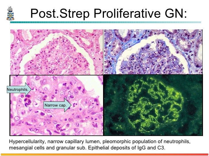 Pathology of Glomerulonephritis