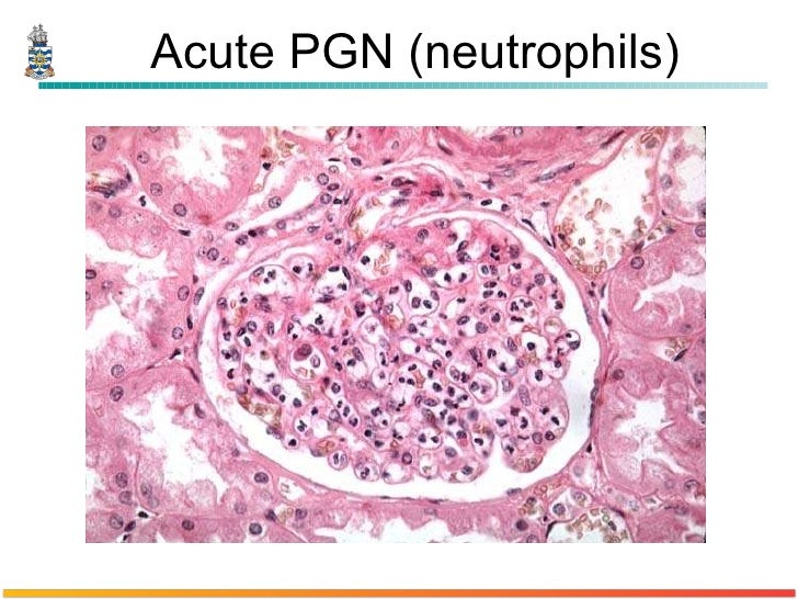 Pathology of Glomerulonephritis