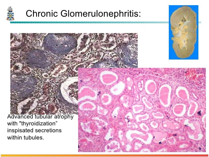 Pathology of Glomerulonephritis