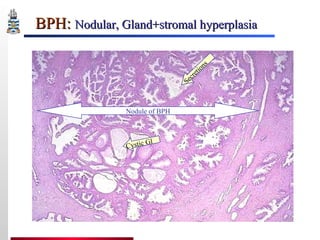 Pathology of Prostate | PPT