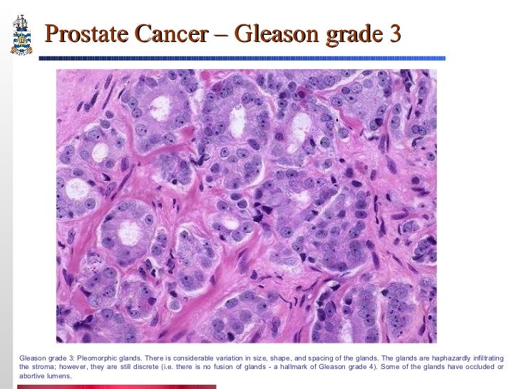 Pathology of Prostate