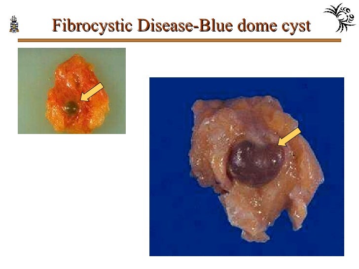 Fibrocystic change blue dome