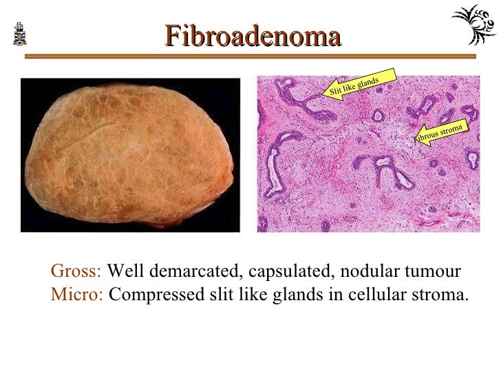 fibroadenoma of breast