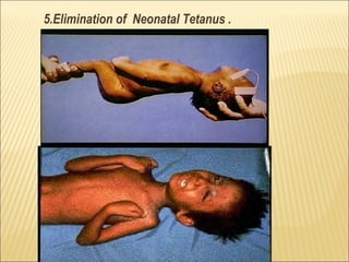 5.Elimination of Neonatal Tetanus .
 