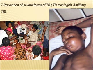 7-Prevention of severe forms of TB ( TB meningitis &military
TB).
 