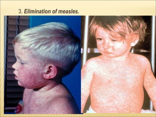 3. Elimination of measles.
 