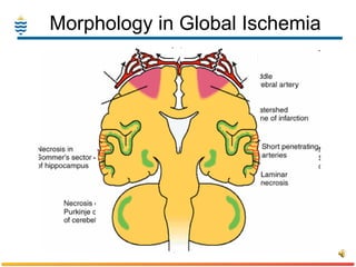 Morphology in Global Ischemia 