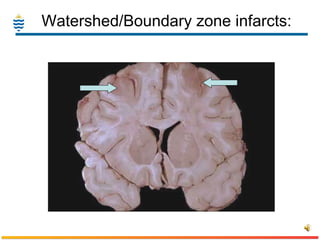 Watershed/Boundary zone infarcts: 