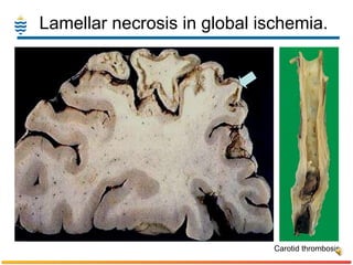 Lamellar necrosis in global ischemia. Carotid thrombosis 