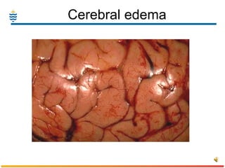 Cerebral edema 