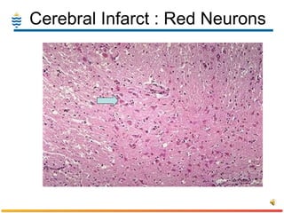 Cerebral Infarct : Red Neurons 