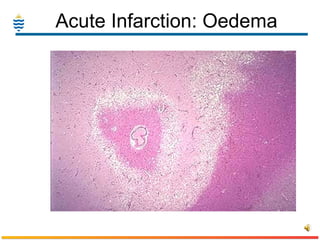 Acute Infarction: Oedema 