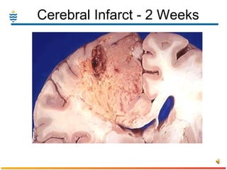 Cerebral Infarct - 2 Weeks 