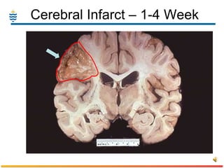 Cerebral Infarct – 1-4 Week  