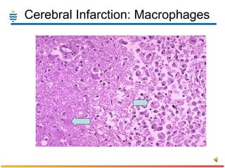 Cerebral Infarction: Macrophages 