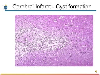 Cerebral Infarct - Cyst formation 