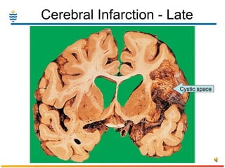Cerebral Infarction - Late Cystic space 