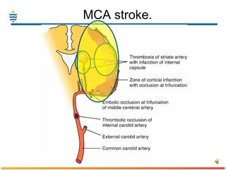 MCA stroke. 