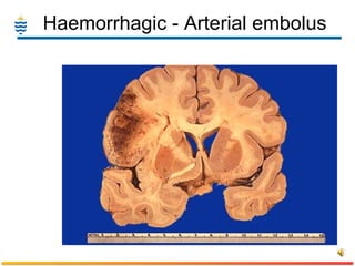 Haemorrhagic - Arterial embolus 