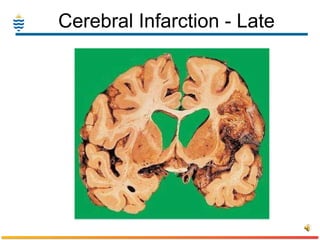 Cerebral Infarction - Late 