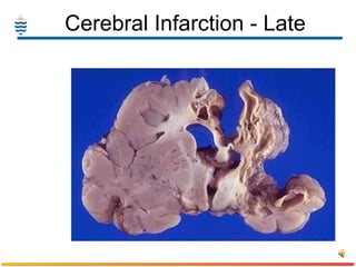Cerebral Infarction - Late 