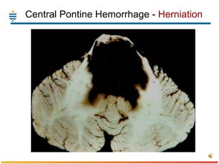 Central Pontine Hemorrhage -  Herniation 