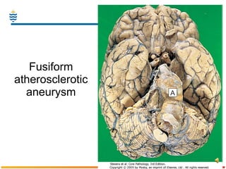 Fusiform atherosclerotic aneurysm 