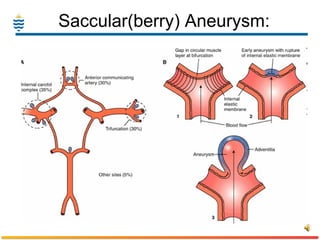 Saccular(berry) Aneurysm:  