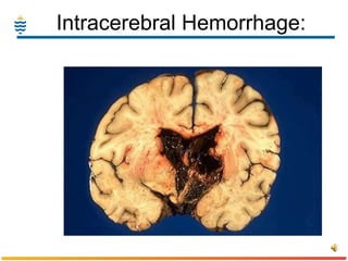 Intracerebral Hemorrhage: 