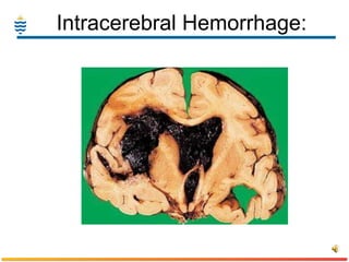 Intracerebral Hemorrhage: 