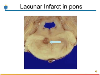 Lacunar Infarct in pons  