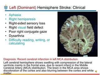 Left (Dominant)  Hemisphere Stroke: Clinical Aphasia   Right   hemiparesis   Right-sided sensory loss  Right  visual  field defect  Poor right conjugate gaze  Dysarthria  Difficulty reading, writing, or calculating   Diagnosis: Recent cerebral infarction in left MCA distribution. Left cerebral hemisphere shows swelling with compression of the lateral ventricle mainly in the frontal area, due to recent infarct in the Middle Cerebral Artery (MCA) distribution. The brain in the MCA area shows discoloration of the cortex and also blurring between the cortex and white matter.  