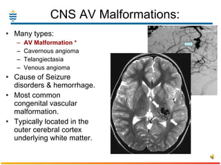 CNS AV Malformations: Many types: AV Malformation * Cavernous angioma Telangiectasia Venous angioma Cause of Seizure disorders & hemorrhage.   Most common congenital vascular malformation. Typically located in the outer cerebral cortex underlying white matter. 