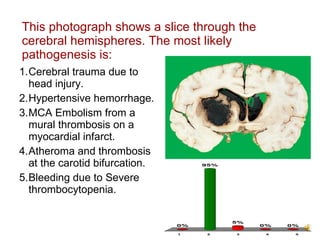 This photograph shows a slice through the cerebral hemispheres. The most likely pathogenesis is: Cerebral trauma due to head injury. Hypertensive hemorrhage. MCA Embolism from a mural thrombosis on a myocardial infarct. Atheroma and thrombosis at the carotid bifurcation. Bleeding due to Severe thrombocytopenia. 