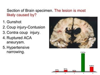 Section of Brain specimen.  The lesion is most likely caused by? Gunshot Coup injury-Contusion Contra coup  injury. Ruptured ACA aneurysm. Hypertensive narrowing. 