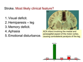Stroke.  Most likely clinical feature?  Visual deficit. Hemiparesis – leg Memory deficit. Aphasia Emotional disturbance. ACA infarct involving the medial and parasagittal aspect of the motor cortex, causing contralateral paralysis of the leg.  