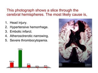 This photograph shows a slice through the cerebral hemispheres. The most likely cause is,  Head injury. Hypertensive hemorrhage. Embolic infarct. Atherosclrerotic narrowing. Severe thrombocytopenia. 