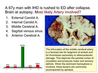 A 67y man with IHD is rushed to ED after collapse. Brain at autopsy. M ost likely Artery involved?  External Carotid A . Internal Carotid A. Middle Cerebral A. Sagittal venous sinus. Anterior Cerebral A. The trifurcation of the middle cerebral artery is a favored site for lodgment of emboli and for thrombosis secondary to atherosclerotic damage. This deprives the parietal cortex of circulation and produces motor and sensory deficits. When the dominant hemisphere is involved, these lesions are commonly accompanied by aphasia.  