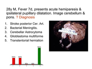 28y M, Fever 7d, presents acute hemiparesis & ipsilateral pupillary dilatation. Image cerebellum & pons.  ? Diagnosis Stroke posterior Cer. Art.  Bacterial Meningitis. Cerebellar Astrocytoma Glioblastoma multiforme Transtentorial herniation 