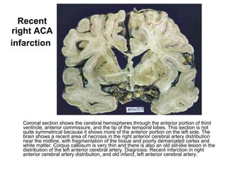 Recent right ACA infarction   Coronal section shows the cerebral hemispheres through the anterior portion of third ventricle, anterior commissure, and the tip of the temporal lobes. This section is not quite symmetrical because it shows more of the anterior portion on the left side. The brain shows a recent area of necrosis in the right anterior cerebral artery distribution near the midline, with fragmentation of the tissue and poorly demarcated cortex and white matter. Corpus callosum is very thin and there is also an old slit-like lesion in the distribution of the left anterior cerebral artery. Diagnosis: Recent infarction in right anterior cerebral artery distribution, and old infarct, left anterior cerebral artery. 