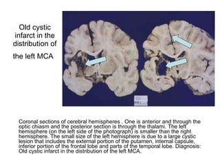 Old cystic infarct in the distribution of the left MCA   Coronal sections of cerebral hemispheres . One is anterior and through the optic chiasm and the posterior section is through the thalami. The left hemisphere (on the left side of the photograph) is smaller than the right hemisphere. The small size of the left hemisphere is due to a large cystic lesion that includes the external portion of the putamen, internal capsule, inferior portion of the frontal lobe and parts of the temporal lobe. Diagnosis: Old cystic infarct in the distribution of the left MCA. 