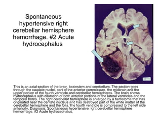 Spontaneous hypertensive right cerebellar hemisphere hemorrhage. #2 Acute hydrocephalus  This is an axial section of the brain, brainstem and cerebellum. The section goes through the caudate nuclei, part of the anterior commissure, the midbrain and the upper portion of the fourth ventricle and cerebellar hemispheres. The brain shows hydrocephalus with dilatation of both anterior portions of the lateral ventricles and the temporal horns. The right cerebellar hemisphere is enlarged by a hematoma that has originated near the dentate nucleus and has destroyed part of the white matter of the cerebellar hemisphere and the folia.The fourth ventricle is compressed to the left side anteriorly. Diagnosis: Spontaneous hypertensive right cerebellar hemisphere hemorrhage. #2 Acute hydrocephalus. 