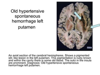 Old hypertensive spontaneous hemorrhage left putamen   An axial section of the cerebral hemispheres. Shows a pigmented slit- like lesion in the left putamen. This pigmentation is rusty brown and within the cavity there is some old blood. The sulci in the insula are prominent. Diagnosis: Old hypertensive spontaneous hemorrhage left putamen.  