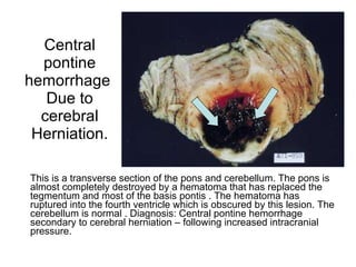Central pontine hemorrhage  Due to cerebral Herniation. This is a transverse section of the pons and cerebellum. The pons is almost completely destroyed by a hematoma that has replaced the tegmentum and most of the basis pontis . The hematoma has ruptured into the fourth ventricle which is obscured by this lesion. The cerebellum is normal . Diagnosis: Central pontine hemorrhage secondary to cerebral herniation – following increased intracranial pressure. 